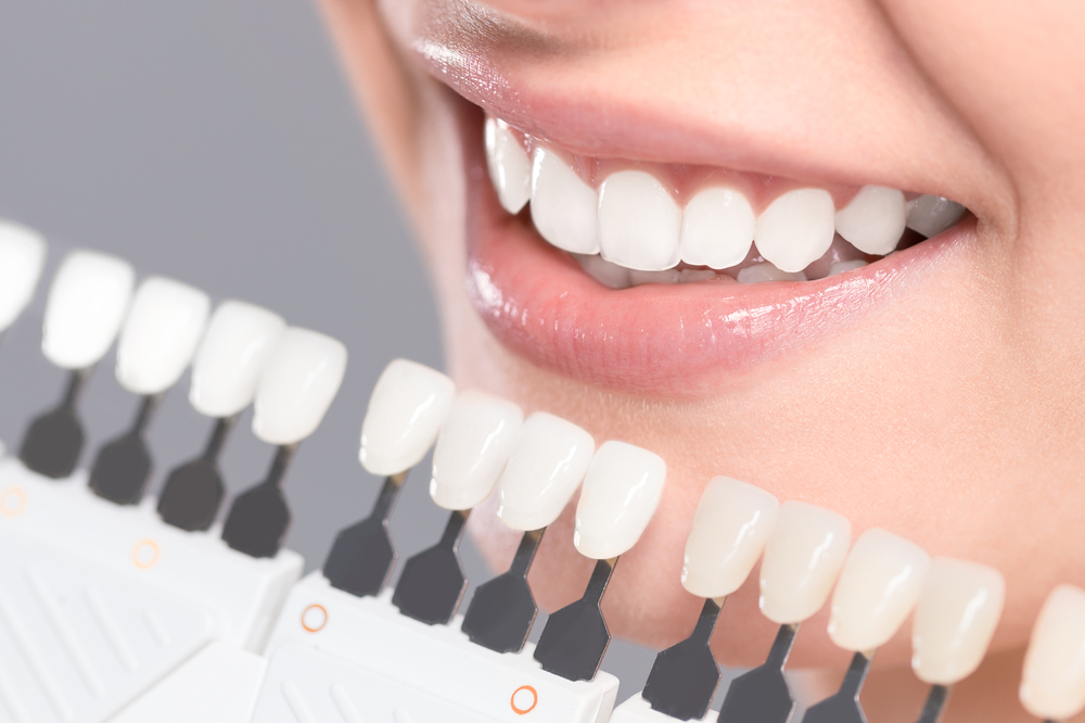 teeth-whitening-reno-south-meadows-dental-orthodontics